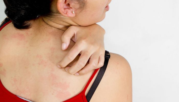 Блошиный аллергический дерматит у людей лечение