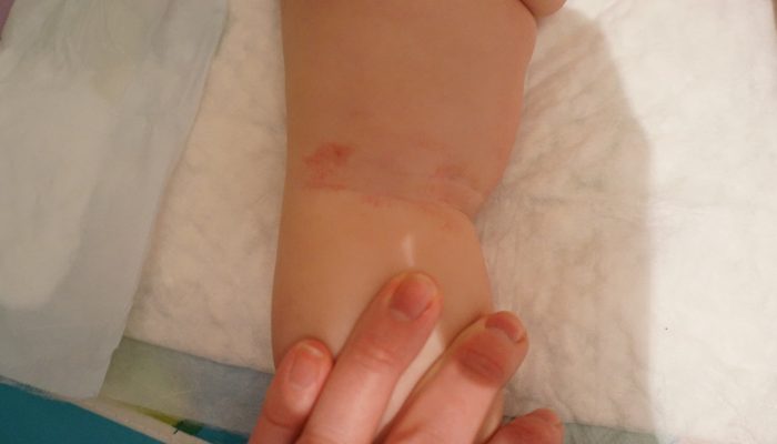 Красные пятна на коже за коленками у ребенка