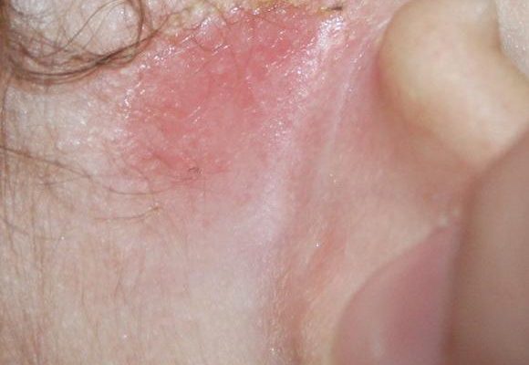 Сыпь за ушами у взрослых причины и лечение