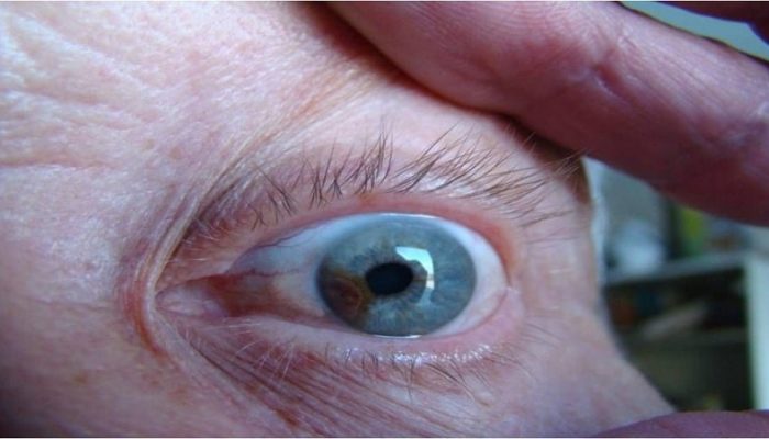 веретеноклеточная пигментная меланома глаза