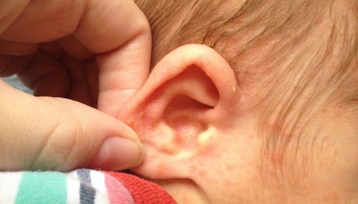 Что означает сыпь за ушами