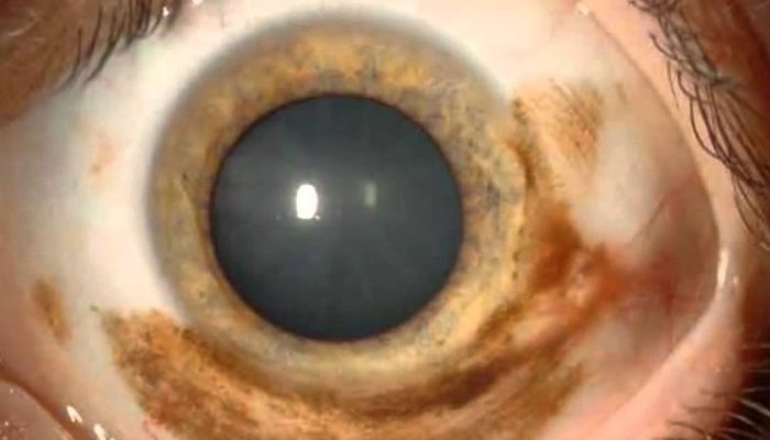 веретеноклеточная пигментная меланома глаза