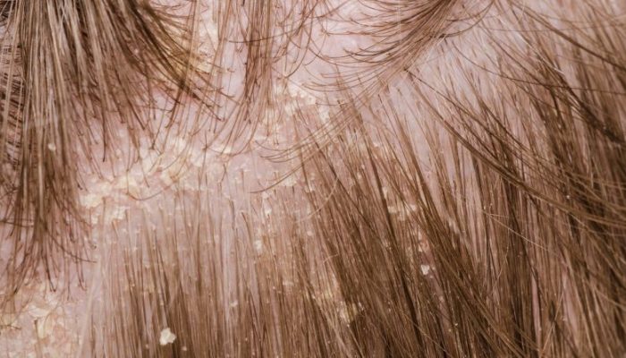 Восстановление роста волос при себореи