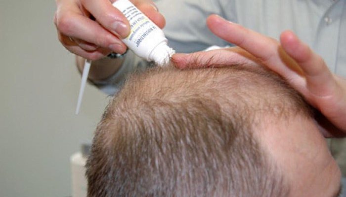 Восстановление роста волос после себорейного дерматита