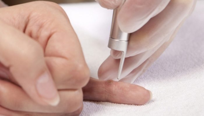 Как лечить рану после удаления бородавки лазером thumbnail