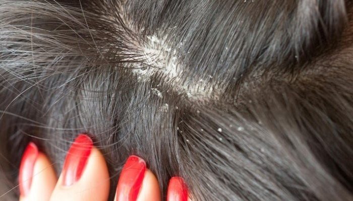 Восстановление роста волос при себореи