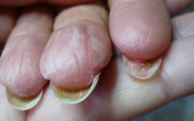 Наросли кожи под ногтем на руке лечение