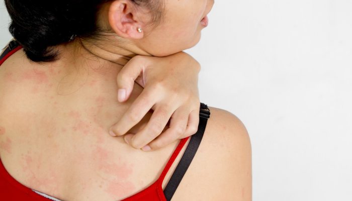 Профилактика кожных заболеваний уход за кожей