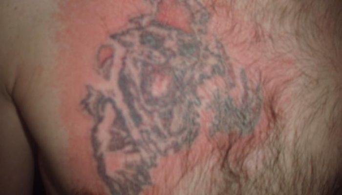 На татуировке мелкая сыпь