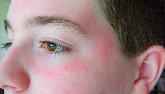 Красные точки вокруг глаз у ребенка и температура