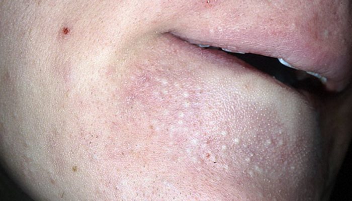 Воспаление желез кожи лица