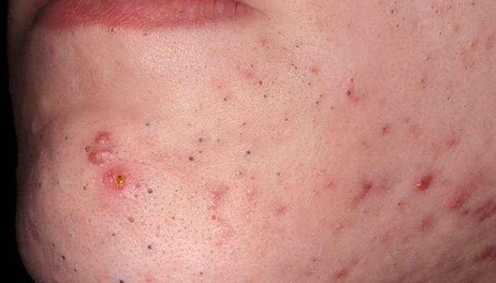 Воспаление желез кожи лица