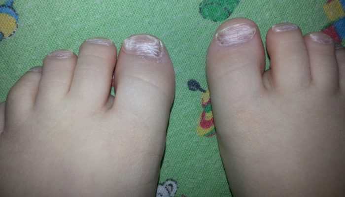 Грибок ногтей на ногах у ребенка 2 года лечение в домашних условиях быстро thumbnail