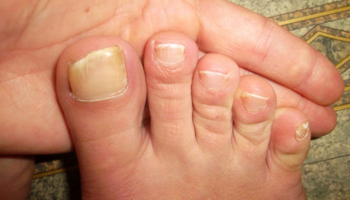 Как вылечить грибок ногтей на ногах у годовалого ребенка thumbnail