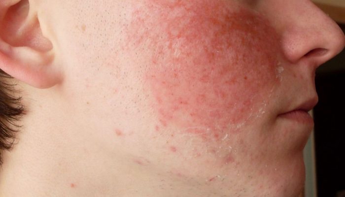 Аллергия на джес что делать