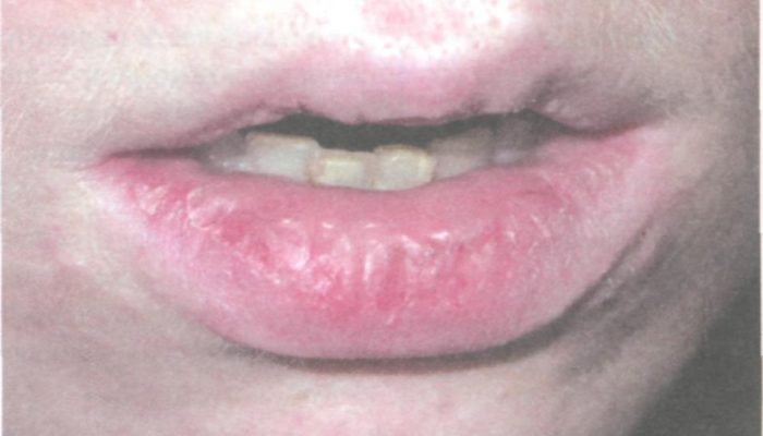 Как вылечить воспаление на губе
