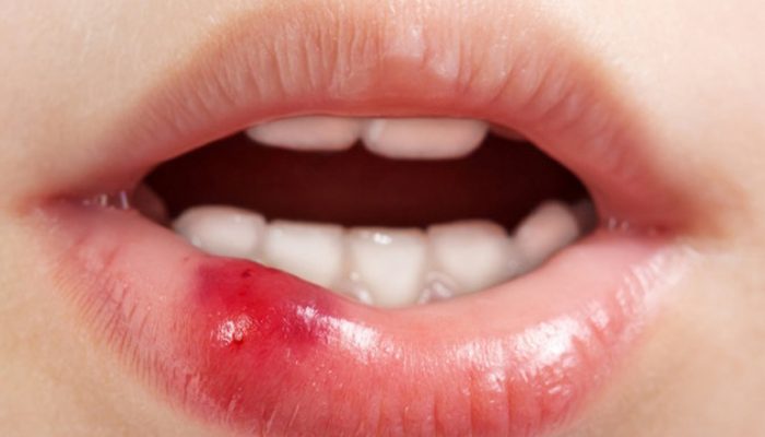 Как вылечить болячку в губе