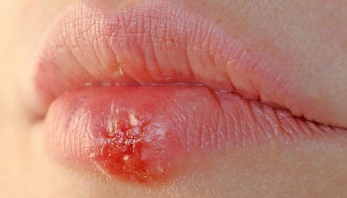 Как вылечить болячки на губах