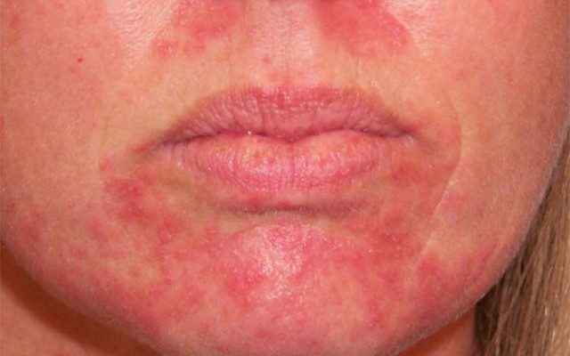 Раздражение кожи лица после эпиляции
