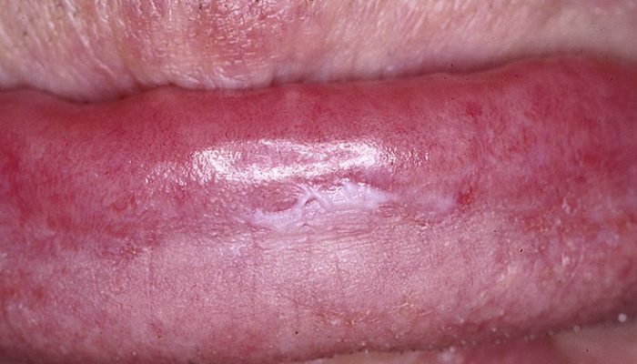 Как вылечить болячку над губой
