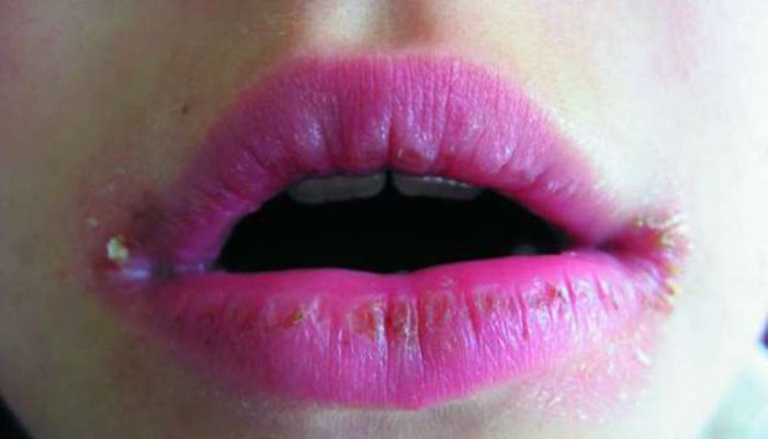Как вылечить воспаление на губе