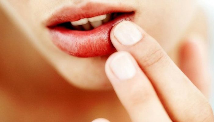Как вылечит губы от болячек