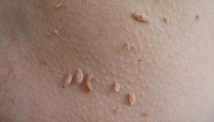Вирусные поражения кожи лица