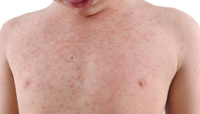 Вирусные заболевания кожи оспа