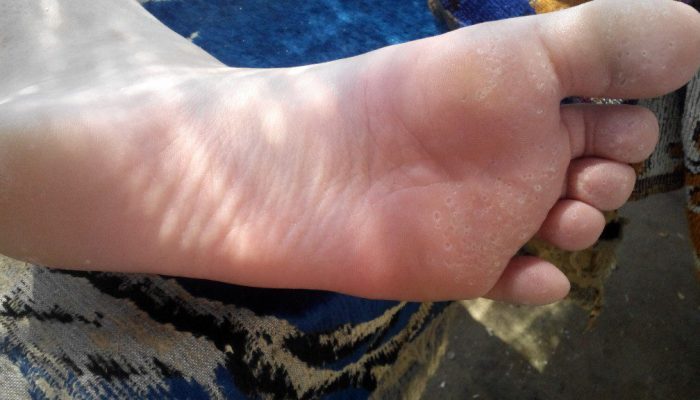 Дырочки на коже стопы ног