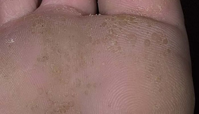 Дырочки на коже стопы ног