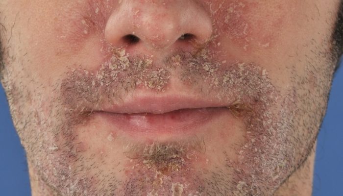 Шелушение кожи на лице у мужчин у переносицы