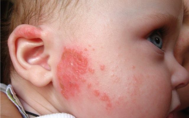 Чем мазать мокнущий атопический дерматит у ребенка